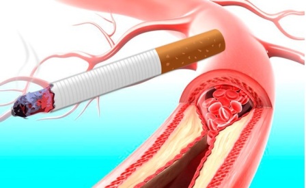 Образование тромба в кровеносном сосуде у курильщика